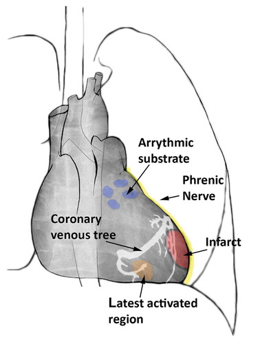 Figure 4. Schematic overview of potential 3D overlay markings onto XRF to guide cardiac resynchronization therapy (CRT) and electrophysiology cardiac interventions. The blue markings show targets for pulmonary vein isolation. In yellow the phrenic nerve is depicted, passing along the epicardium of the left ventricle. In red an infarcted region is visualized with corresponding border zone marked in black. The orange region is showing the latest activated area along with the coronary venous tree depicted in white