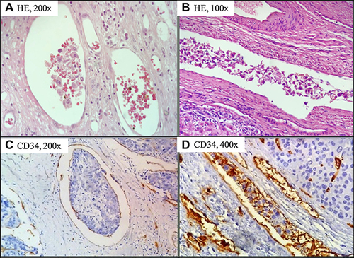 Figure 1 Examples of vascular invasion by HCC in thin-walled vessels stained by (A and B) HE, and (C and D) CD34 IHC methods. We observe vascular vessels lined by endothelium containing neoplastic emboli.