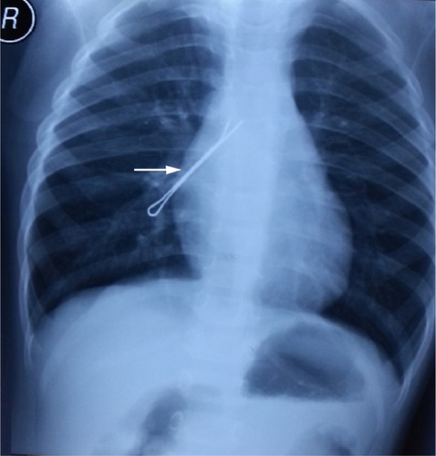 Figure 2 A representative case of TFB (arrow) detected by chest X-ray examination.