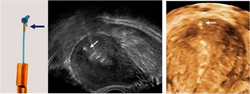 Figure 7 The current intrauterine device (IUD) is provided with a “visualized” anchor.