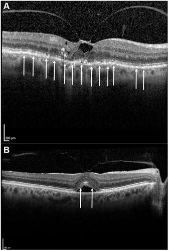 Figure 1 Example SD-OCT images depicting ellipsoid zone disruptions prior to treatment with ocriplasmin. Panel (A) Example of an eye with generalized disruptions of the ellipsoid zone. Arrows depict multiple areas of ellipsoid zone disruption not solely localized around a corresponding anatomic lesion. Panel (B) Example of an eye with focal disruption of the ellipsoid zone. Arrows depict areas of ellipsoid zone disruption localized around the area of vitreomacular traction.