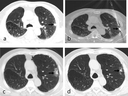 Figure 2. Axial CT images of a 76-year-old man with stage IA NSCLC (squamous carcinoma) with IPF who underwent CT-guided synchronous percutaneous CNB and MWA. (a) CT prior to MWA treatment showed a 1.4 × 0.9 cm subpleural lesion in the left upper lobe (arrow); (b) CT findings during MWA treatment, the antenna punctured the Central position of the lesion through honeycomb lesions (arrow); (c) CT image 24 h post-procedure showed ground-glass opacity around the tumor (arrow); (d) the 12-month CT image after MWA treatment revealed gradual shrinkage of the ablated lesion, and it became a fiber scar (arrow). CT: computed tomography; NSCLC: non-small cell lung cancer; CNB: core-needle biopsy; MWA: microwave ablation; IPF: idiopathic pulmonary fibrosis.