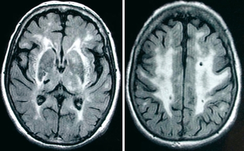 Figure 2. MRI of a 56-year-old woman with CADASIL suffering from depression and with executive dysfunction, and showing diffuse white-matter hyperintensities and small deep infarcts located in the thalamus and within the centrum semi-ovale.