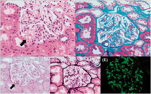 Figure 2. Pathology of kidney biopsy: (A: HE staining; B: PAS staining; C: PASM staining) partial glomerular ischemia shrinkage, an area of balloon adhesion, local capillary loop cavity dilation, plasma protein-like exudation in segmental capillary lumen and Bowman capsule wall, glomerular podocyte swelling, mesangial matrix slightly expanded (black arrows: the balloon adhesion). (D: Masson staining) mesangial area suspected a small amount of eosinophilic protein deposition. (E: Immunofluorescence staining) IgM (3+) deposition in the mesangial region.