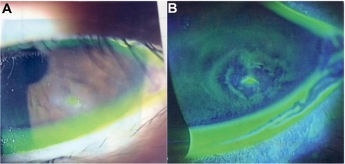Figure 2 Slit lamp images from 2 months after the start of treatments.