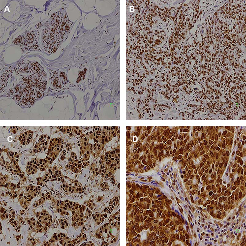 Figure 1 Presentative IHC images of cytoplasmic HuR expression levels from 394 breast cancer tissues. (A) Staining: 0 points; (B) staining: 1 point; (C) staining: 2 points; (D) staining: 3 points.