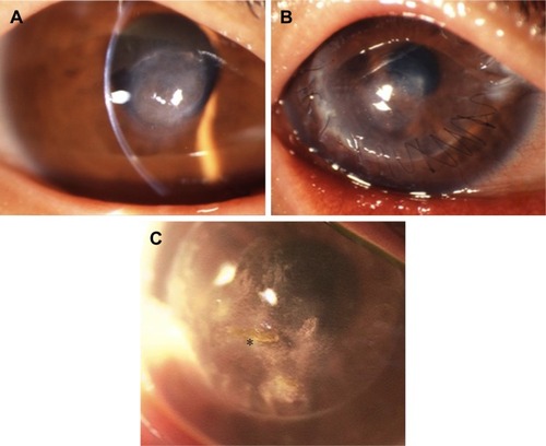 Figure 2 Corneal findings of a 37-year-old DALK/KC female patient (case #7).