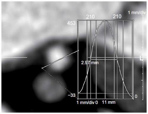 Figure 1 The measurement of the diameters of each vessel using the full width at half maximum method.