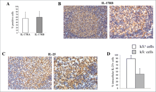Figure 1. Expression of IL-25R and IL-25 in primary tumor cells from patients with FL, DLBCL or BL. (A) MNCs from B-NHL lymph nodes were double stained with anti-Ig κ or anti λ mAbs in combination with anti IL-17RA or anti IL-17RB mAbs, and analyzed by flow cytometry gating on the cell fraction expressing monoclonal κ or λ chains. Results for 10 FL, 6 DLCBL and 3 BL cases are shown in histograms, as mean % positive cells +SD. (B) Immunohistochemical analysis of IL-17RB in representative lymph nodes from patients with FL (X200 left panel and X400 right panel). IL-17RB is expressed in the neoplastic GC of FL. (C) Immunohistochemical analysis of IL-25 in representative lymphnodes from patients with FL. IL-25 expression is diffusely distributed among FL cells and associated microenvironment components (X200 left panel and X400 right panel). (D) Cell suspensions from B-NHL lymph nodes were surface stained with anti-Ig κ and anti λ mAbs, permeabilized, stained intracellularly with anti-IL-25 mAb and analyzed by flow cytometry gating on the cell fraction expressing monoclonal κ or λ chains. Results are means % positive cells from 5 FL, 3 DLCBL and 2 BL cases pooled together +SD.
