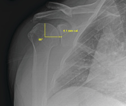 Figure 1. External true anteroposterior view radiograph showing an osteoarthritis shoulder with glenohumeral space measurement technique overlaid in yellow.