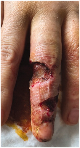 Figure 9. Skin after sucessive surgical debridements and sterile dressings (5 weeks).