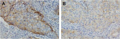 Figure S3 The expression of PD-L1 by immunohistochemical staining with a membranous pattern.Note: Baseline staining (A) and 4 weeks after gefitinib treatment (B).Abbreviation: PD-L1, programmed cell death ligand-1.