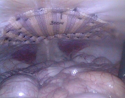 Figure 3. 4 cm unclosed repair immediately after defect closure and fixation of mesh using SorbaFix™ Absorbable Fixation System fasteners in a double crown technique.