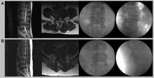 Figure 2 (A) Patient A; (Left) the sagittal and axial T2-weighted lumbar spine MRI shows a massive right central herniated lumbar disc at L4-5. (Right) The wand with a curved tip is inserted into the L4-5 intervertebral disc to perform the percutaneous disc decompression, and the tip is placed near the herniated disc. (B) Patient B; (Left) the sagittal and axial T2-weighted lumbar spine MRI reveals a large right central herniated lumbar disc at L5-S1. (Right) The wand is inserted into the L5-S1 intervertebral disc with the tip placed near the herniated disc.