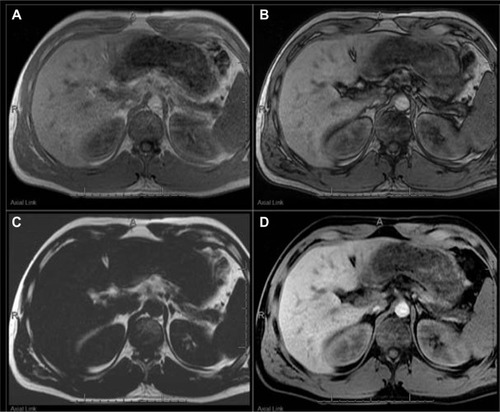 Figure 12 MRI of the abdomen with the Dixon technique.