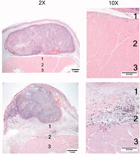 Figure 7. These photomicrographs acquired 24 h post mNPH treatment, demonstrate the morphological changes observed in two different tumours which received an identical thermal dose (CEM60). Both tumours show extensive uniform necrosis. The lower tumour demonstrates significant oedema in the space between the tumour and underlying muscle (zones 1 and 2). Although minor inflammation was seen, including mNP-containing macrophages, there was no haemorrhage or necrosis in the overlying skin or peritumoral tissue.