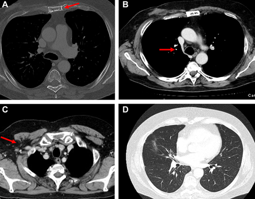 Figure 9 CT scan evaluation after treatment. (A) Red arrows in the figures show sternum lytic metastasis, (B) mediastinal lymph node, (C) axillary lymph node, and (D) lung metastasis.