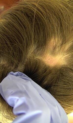 Figure 4 Clinical image demonstrates alopecia in lupus panniculitis of the scalp with notable erythema and lack of keratotic plugs or scale.