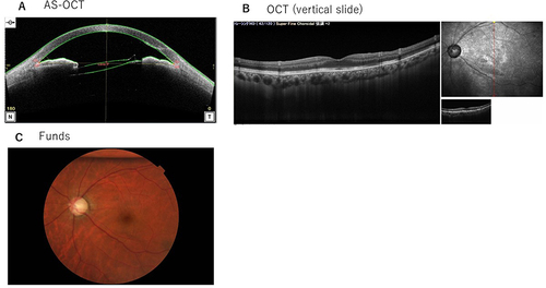 Figure 5 Patient 2’s AS-OCT results at 11 days after C3F8 gas tamponade treatment. (A) The AS-OCT demonstrated that the ciliary body was attached. (B and C) OCT and Fundus results at 55 days after the C3F8 gas tamponade treatment. (B) OCT showed that the retinal folds were improved. (C) Fundus results: approx. 20% of the C3F8 gas remained in the vitreous cavity. The retinal folds were improved.