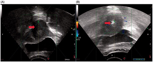 Figure 2. Monitoring ultrasound images obtained from a 39-year-old patient with a retroverted uterus. The bladder was filled with 300 mL of normal saline and lay between the uterus and abdominal wall. (A) Pre-HIFU ultrasound image showed a 4.1 × 3.9 × 3.8 cm of uterine fibroid located at the posterior wall of the uterus (arrow). (B) Intra-HIFU ultrasound image showed a significant greyscale change area in the fibroids (arrow).