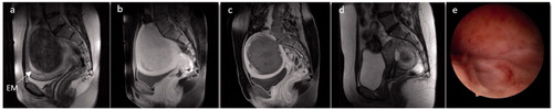 Figure 3. Images from a 30-year-old woman with vaginal delivery after USgHIFU ablation for a myoma. She had menorrhagia, severe anemia (hemoglobin of 9 g/L) and secondary sterility. (a) T2-weighted image before USgHIFU showing an enlarged uterus with a transmural hypointense myoma of 10 cm (463 cm³). (b, c) T1-weighted contrast-enhanced images. (b) Before USgHIFU the myoma had homogenous vascularization lower than that of the surrounding myometrium. (c) After USgHIFU treatment the entire myoma volume was not perfused. (d) T2-weighted image 6 months later showed a reduction in the size of the myoma to 3.9 cm³. The patient underwent a hysteroscopic resection of the remaining myoma fragment. (e) The hysteroscopic image after HIFU and surgery showed a normal uterine cavity. The woman became pregnant spontaneously 3 months later and gave birth to a healthy baby weighing 3.5 kg. EM, endometrium.
