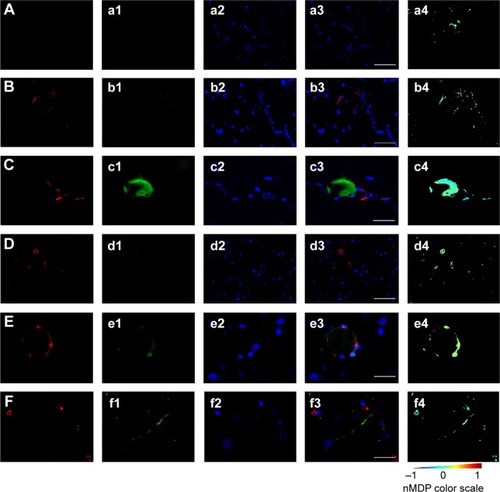 Figure 9 Immunofluorescence for anti-tubulin III on cerebral cortex sections from gH625-NBD-treated animals.Notes: (A) Neurons appear largely without labeling for gH625-NBD, while the peptide signal is restricted to narrow areas (arrows). (B) In some neurons, gH625-NBD colocalizes with anti-tubulin III near the perikaryon. Other cytotypes are also labeled for gH625-NBD (arrow head). (C) DAPI staining of neuron nuclei. (D) Neurons immunoreactive for anti-tubulin III (magenta: false color) in the perikaryon and axons. (E) The same field in the fluorescein isothiocyanate channel shows the same neuron in (D) which is strongly labeled for gH625-NBD. (F) nMDP distribution colocalization color map of overlapping (D) and (E); the image clearly shows that gH625-NBD colocalizes with anti-tubulin III in the perikaryon and the axon emergence, exclusively. (G) Merged image of the aforementioned three channels, ie, DAPI, AlexaFluor594, and fluorescein isothiocyanate. Scale bar: 50 μm for (A, B) and 10 μm for (C–G).Abbreviations: NBD, 7-nitrobenz-2-oxa-1,3-diazole-4-yl; DAPI, 4,6-diamidino-2-phenylindole; nMDP, normalized mean deviation product.