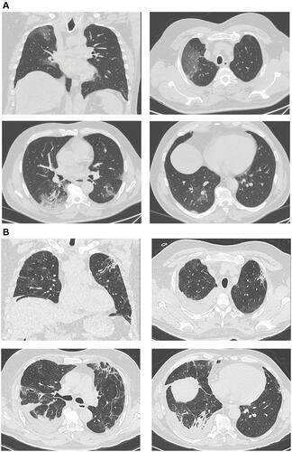 Figure 2 (A) Case 2. Multiple patchy, nodular or large opacity and GGO under the pleura, with poorly defined margins and few consolidations at the right lower lobe. (B) Case 2. Right sided pleural effusion and the presence of sub-pleural consolidations and reticular thickening involving the upper lobes.