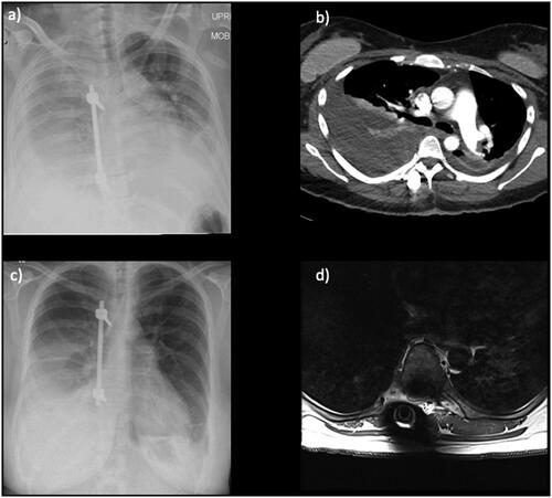 Figure 4. Case of benign thoracic spine tumour with immediate post-operative chest x-rays (a) and CTPA (b) showing pleural effusion. After a period of Liquoguard-driven lumbar drainage, a repeat chest x-ray 5 days later (c) shows interval improvement, and a delayed MR 4 months later shows resolution of effusion at the lung bases (d).