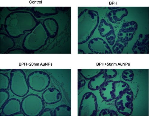 Figure 4 Effect of AuNPs treatment on the histomorphological changes of prostate sections (hematoxylin staining; magnification, ×100). Control group shows no histological alteration in the prostate gland. BPH group exhibit more proliferation in the glandular epithelial and stromal area with several papillary projections into the lumen. BPH +20 nm AuNPsgroup but not BPH +50 nm AuNPs show marked reduction in the epithelial hyperplasia, and the intraluminal papillary folds induced by testosterone.Abbreviations: BPH, benign prostatic hyperplasia; AuNPs, gold nanoparticles.