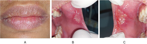 Figure 1 Clinical features at the first visit; (a) Dry and exfoliative lips; (b) another ulcer with a white base surrounded by erythematous areas, clear boundaries, irregular with a size of 1×0.5 cm, sore on the left buccal mucosa; (c) Right buccal mucosa.