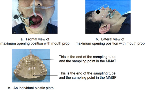 Figure 1 Frontal (a) and lateral (b) views of a mouth maximally opened due to the use of a mouth prop; an individual plastic plate (c). An individual plastic plate (an oral appliance) was created to measure the OC in the MMAT and MMSP. In addition, Frontal (a) and lateral (b) views showed the maximum opening position with a mouth prop at Term 1 and Term 2.
