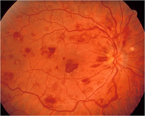 Figure 4 Paracentral acute middle maculopathy in a 56-year-old male patient with Covid-19 infection (Picture from the collection of the Ophthalmology Department, Medical University of Bialystok).