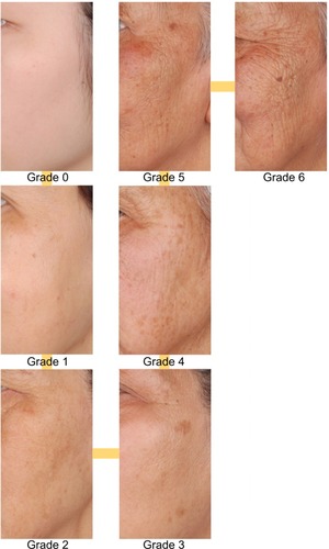 Figure 2 Clinical standardized photographic scale of “importance of facial skin surface texture presenting alteration”.