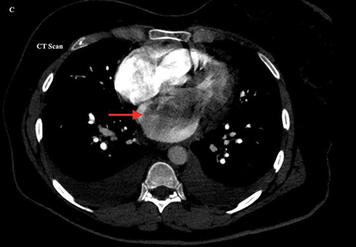 Figure 1. Computerized Tomography of the chest with contrast showing a giant hypodense filling defect in the left atrium suspicious for a mass lesion