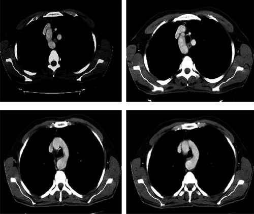 Figure 2 Left and right arches in the trachea are equal in size, but the right arch was 5 mm higher than the left.