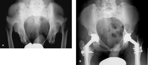 Figure 1. Case no. 2. Congenital dislocated hips bilaterally; grade D according to Efthkhar. A. Preoperatively. B. Postoperatively, the acetabular components (Mallory head) were seated in the true acetabulum. A straight cementless dysplasia stem (Biomet) with a 22-mm head was used. The greater trochanter was fixated with 2 screws. A prophylactic cable was placed around the femur before insertion of the stem.