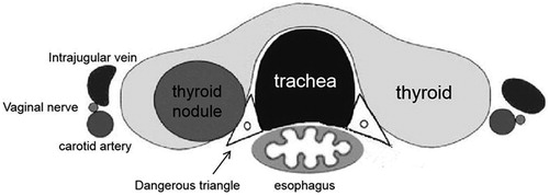 Figure 2. Dangerous thyroid triangle.
