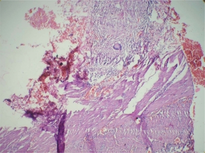 Figure 2 Histopathology slide showing the presence of epitheloid granulomas and Langhans-type giant cells and evidence of endarteritis, which is suggestive of tuberculous etiology.