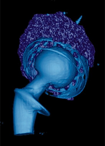 Figure 2. 3-D rendering of bone graft volume.