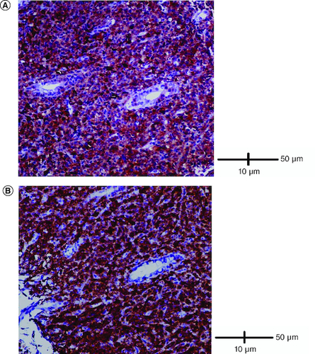 Figure 4. Immunohistological analysis.(A) Cells were diffusely positive for CD4 (IHC × 200). (B) Cells were diffusely positive for CD8 (IHC × 200).