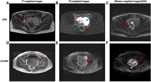 Figure 7 (A–C) Leiomyosarcoma (LMS) in a 56-year-old woman. (A) Axial MRI in a T1-weighted image shows tumor cystic degeneration (blue arrow) and local high signal intensities (red arrow). (B) T2-weighted fat-saturated image shows heterogeneous high signal intensities in the mass. The solid component shows slightly high signal intensity (green arrow); the cystic change area shows significantly high signal intensity (blue arrow); the bleeding area has different signal intensity due to different bleeding time (red arrows). (C) Axial b800 DWI demonstrated restricted diffusion of the solid components in the mass (red arrow). (D–F) Uncertain malignant potential (STUMP) in a 48-year-old woman. (D) Axial MRI in a T1-weighted image shows interspersed hyperintensities (red arrow). (E) T2-weighted fat-saturated image shows heterogeneous high signal intensities (red arrow). (F) Axial b800 DWI demonstrated restricted diffusion of the solid components (red arrow).