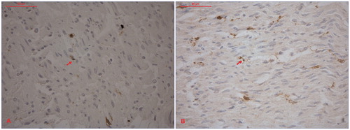 Figure 1. Immunohistochemic analyses of gastric antrum wall autopsy specimens visualizing c-Kit-IR ICC (dark brown) in (A) a patient with hereditary TTR amyloidosis and (B) a non-amyloidosis control. A × 40 objective (40×/0.70, Pl Fluotar, Leica) was used for the analyses. IR = immunoreactive. ICC = interstitial cells of Cajal. TTR = transthyretin.