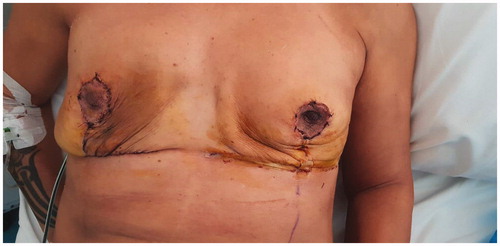 Figure 5. Postoperative image, bilateral tissue expanders and free nipple grafts.