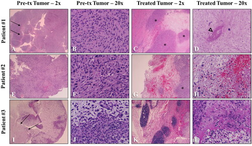 Figure 4. Patient-matched low- (A, C, E, G, I, K) and high-magnification (B, D, F, H, J, L) histology images comparing pretreatment (tx) and treated STS tumor samples. (A-B, E-F, I-J) Prior to histotripsy treatment, all tumors were microscopically characterized by densely cellular regions of spindle cells on a variably collagenous stroma (A-B, E-F, I-J). Occasional regions of coagulative necrosis and hemorrhage were observed in pretreatment tissues (arrows). Following histotripsy, treated tissues were characterized by large foci of coagulative necrosis (D) and/or scattered lytic necrosis (H, L), acute hemorrhage (G-H), and rare necrosis of vessels (D) (arrowhead). Intact tumor cells remained in all treated sections (asterisks). Image magnifications are reported in the figure headings.