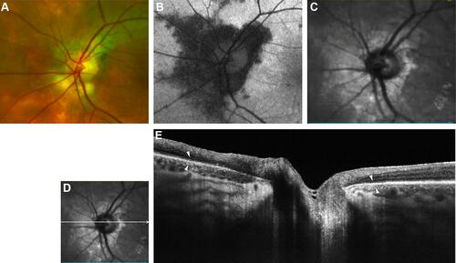 Figure 1 Left optic nerve head of patient 1. (A) Color optic disc photo with a peripapillary halo (PPH). (B) Fundus autofluorescence (FAF) of optic nerve head shows hypo-autofluorescent lesions possibly indicating thinning and interruption of retinal pigment epithelium (RPE). (C) Red free image of the optic nerve head showing the extent of PPH. (D and E) B-scan of swept-source optical coherence tomography (SS-OCT) image showing thinning and focal loss of RPE with hyper-reflectivity of underlying choroid in the peripapillary region with white arrowheads marking the extent of PPH.
