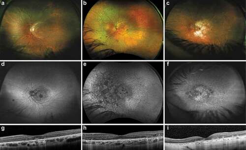 Figure 2. Fundus imaging of patients with RCBTB1-associated retinal dystrophy.