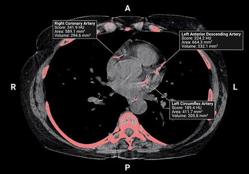 Figure 2 A non-contrast, ungated chest CT scan from a 69-year-old male with COPD (FEV1, 30%Pred). Image was acquired during inspiratory breath-hold and shows calcium in the right coronary, left anterior descending, and left circumflex arteries. Created with Biorender.com.