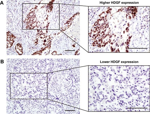 Figure 1 Representative figures of higher (A) and lower (B) HDGF immunohistochemistry staining in clinical samples of EOC.