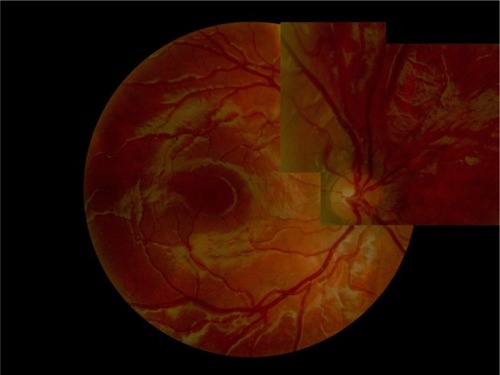 Figure 2 Color fundus photograph composition of this patient’s right eye. Optic nerve, vessels, and macula are normal. Notice the retinal nerve fiber layer, especially detectable around the fovea and vasculature, a normal finding in children.