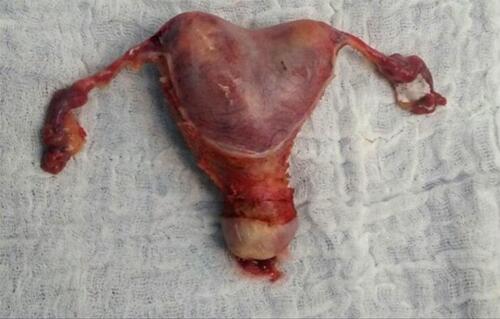 Figure 5 Bicornuate uterus.